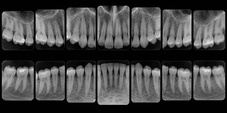 Levantamento periapical completo: catorze radiografias, cada uma mostrando um grupo de dentes da coroa à raiz