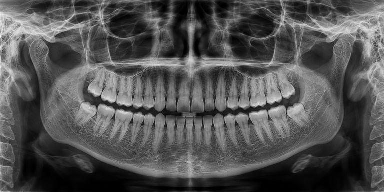 Radiografia panorâmica mostrando todos os dentes, maxilares e mandíbula em uma única imagem