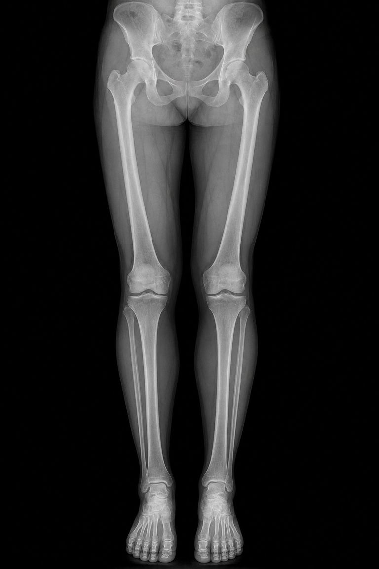 Radiografia de membros inferiores da bacia aos pés, com fêmur, joelhos, tíbia e tornozelos
