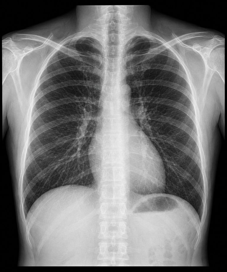 Radiografia de tórax em incidência frontal, mostrando pulmões, coração e arcos costais