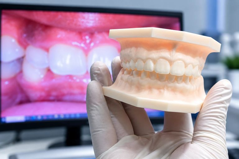 Mão de luva segurando o modelo 3D impresso das arcadas, com o escaneamento intraoral na tela ao fundo